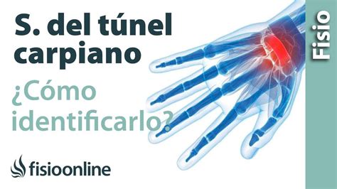 Síndrome del túnel carpiano o canal del carpo Diagnostico y