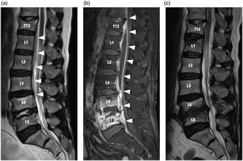 Salmonella Spondylodiscitis And Epidural Abscess Successfully Treated