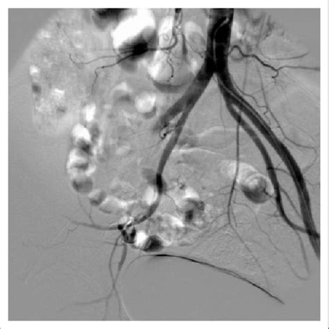 Ct Angiography Demonstrated Total Occlusion Of The Right Common Iliac Download Scientific