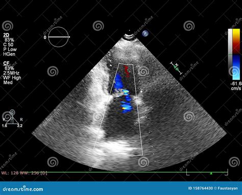 Screen Of Echocardiography Ultrasound Machine Stock Photo Image Of