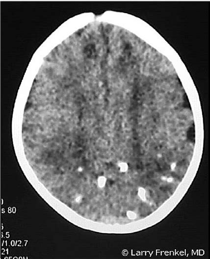 Periventricular Calcifications In Congenital Cmv Infection Reprinted