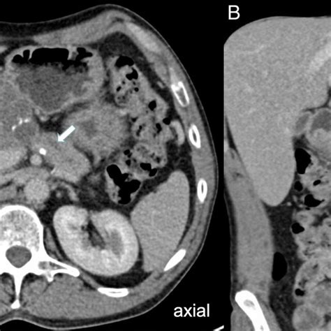 Contrast Enhanced Computed Tomography Ct Scan Revealed A Septated