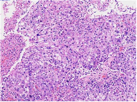 Breast Mass Histology Showing Squamous Cell Carcinoma Download