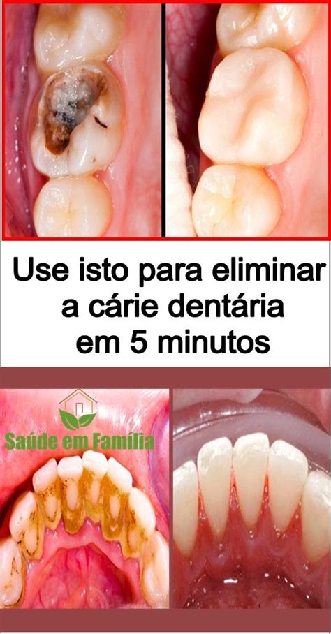 Está Querendo Eliminar A Cárie Dentária E Não Consegue Então Este