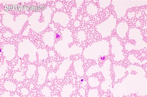 Picture Of White Blood Cell Red Blood Cell And Platelet In Blood Film