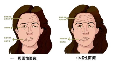 周围性面瘫的病因和治疗 — 知识分享 哔哩哔哩