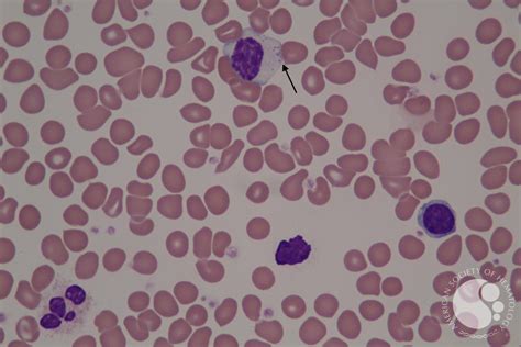 Large Granular Lymphocyte in T-LGL Leukemia