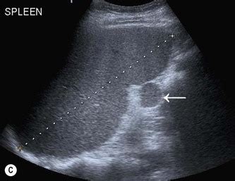 Ultrasound of the spleen and lymphatic system | Radiology Key