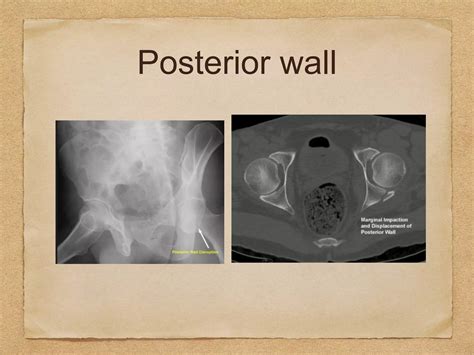 Acetabular Fracture Radiology Xrays Ct Scan And 3d Printing Ppt