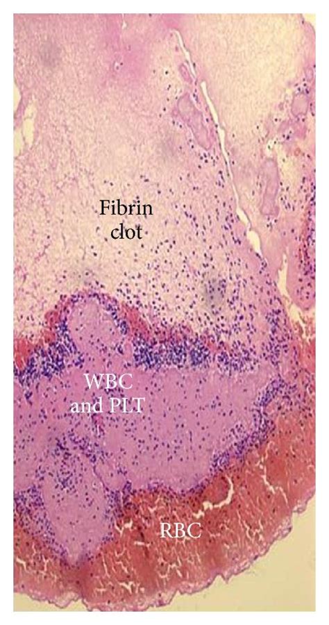 Preparation And Structure Of Platelet Rich Fibrin Prf A Shows