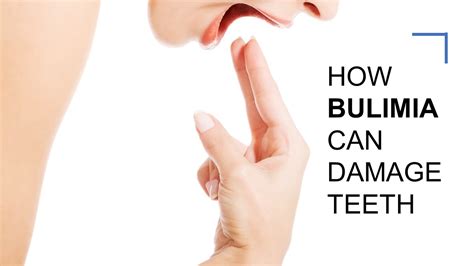 PPT How Bulimia Can Damage Teeth PowerPoint Presentation Free To