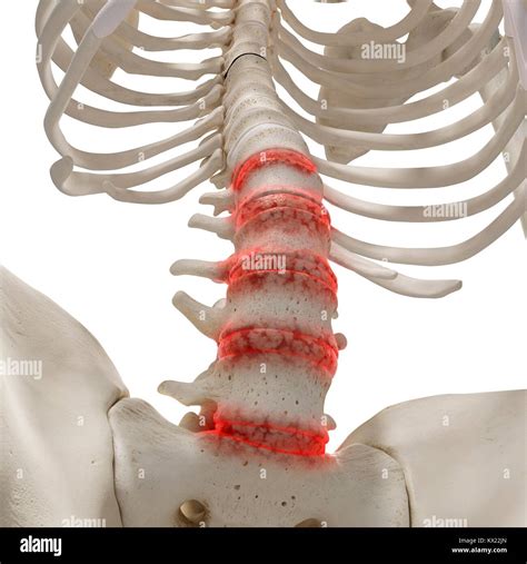 Arthritis in the lumbar spine, illustration Stock Photo - Alamy