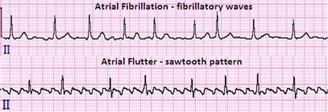 Atrial Flutter Ablation Rhythm And Cardiac Specialists