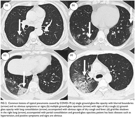 Clinical and radiological characteristics of COVID-19: a multicentre