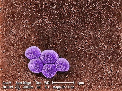 Staph Aureus Scheme Cuts Surgical Infection