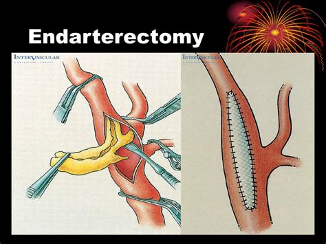 Femoral Endarterectomy Procedure