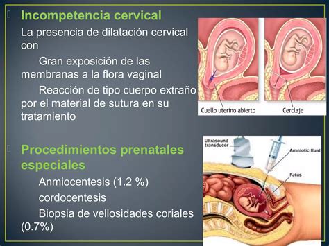 Ruptura Prematura De Membranas Ppt Descarga Gratuita