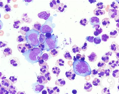 Lymphomatous peritoneal effusion - 2.