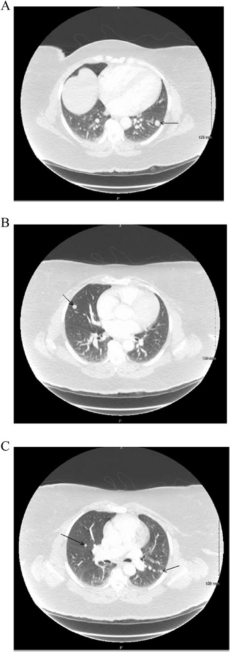 A Ct Chest With Pe Protocol Showing A Non Calcified 14 Mm Pulmonary Download Scientific