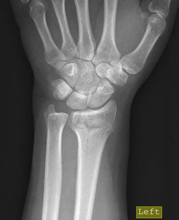 Distal Radial Fracture Radiology Case Radiopaedia Org