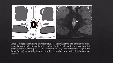 Radiological Imaging In Perianal Fistula Ppt