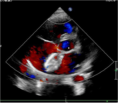 Transthoracic echocardiography at 1-month post-procedure showed that ...