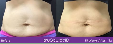 TruSculpt ID Miami Innovative Aesthetics