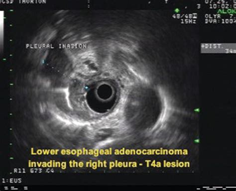 Esophageal Cancer Radiology Key