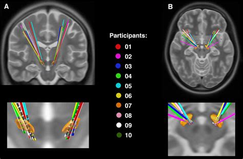 Localisation Of Subthalamic Deep Brain Stimulating Electrodes Using