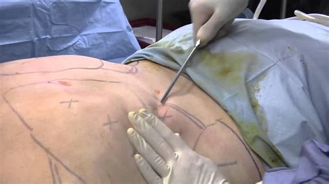 Liposuction Surgery YouTube