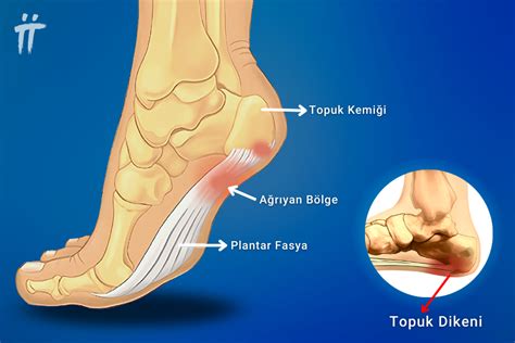 Topuk Dikeni Nedir Belirtileri Tanısı ve Tedavisi Turan Turan