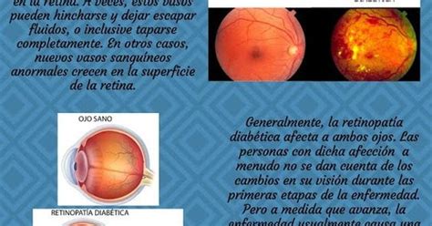 Clínica de Ojos Oftalmic Láser RETINOPATÍA DIABÉTICA