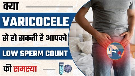 क्या Varicocele से हो सकती है आपको Low Sperm Count की समस्या 3 Tips