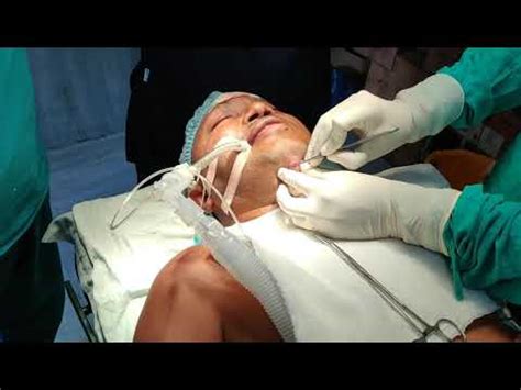 Submental Intubation YouTube