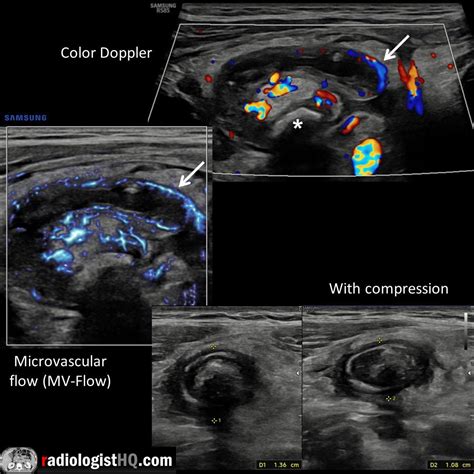 Acute Appendicitis On Ultrasound R Radiology