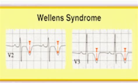 Wellens Syndrome Symptoms