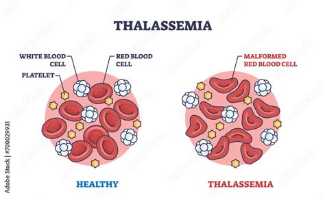 Thalassemia Blood Disorder Caused By Lack Of Hemoglobin Outline Diagram