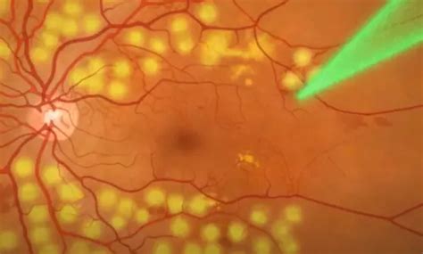 Retinal Laser Photocoagulation: Purpose, Procedure, Risks