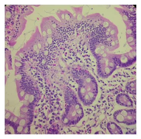 Photomicrography Of A Duodenal Mucosal Biopsy Specimen X Shows A