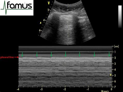 Thoracic Ultrasound Theory - FAMUS