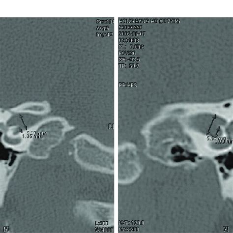 The Measurement Of The Vertical Diameter Of The Internal Auditory Canal