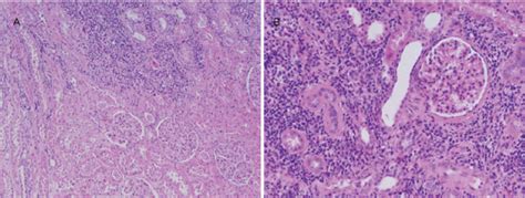 Pathology Of Igg Related Kidney Disease The Boundary Between The