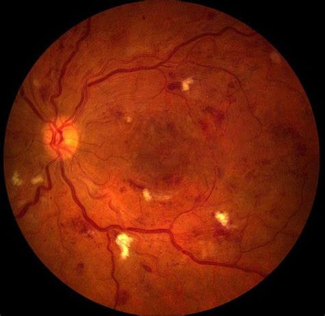 Pjsaine Retinal And Fundus Photography Fluorescein Angiography