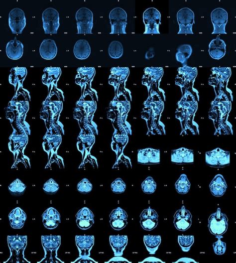 Imagen de resonancia magnética resonancia magnética del cerebro