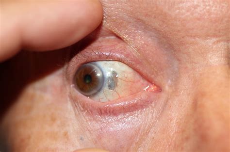 What Radiation Melts The Eye Eyes And Faces