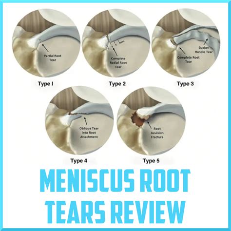 Assessment of Meniscus Root Tears - foppa.casa