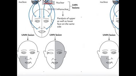 Mechanism Of Facial Bell S Palsy And Clinical Interpretation Youtube