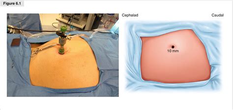 Laparoscopic Extended Right Colectomy Springerlink