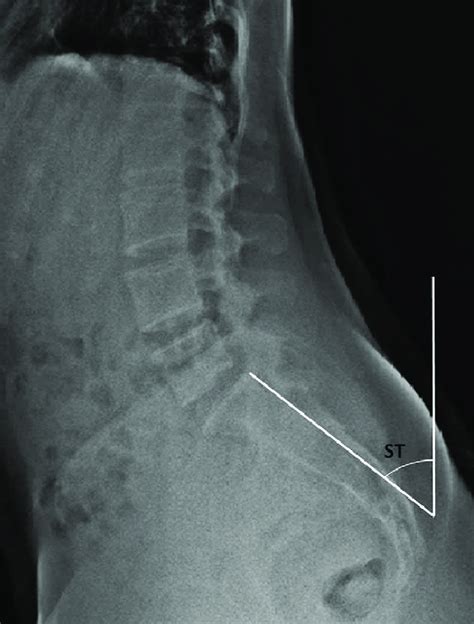 Measurement Of The Sacral Tilt St Angle On A Lateral Lumbar