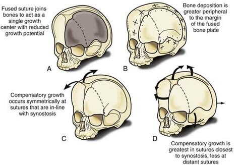 Craniosynostosis | Neupsy Key